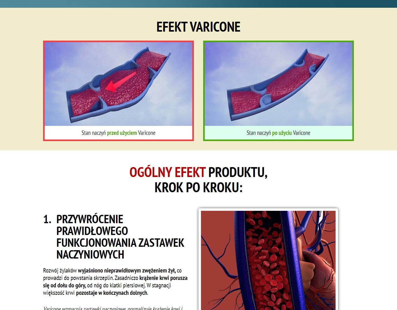 Varicone 5